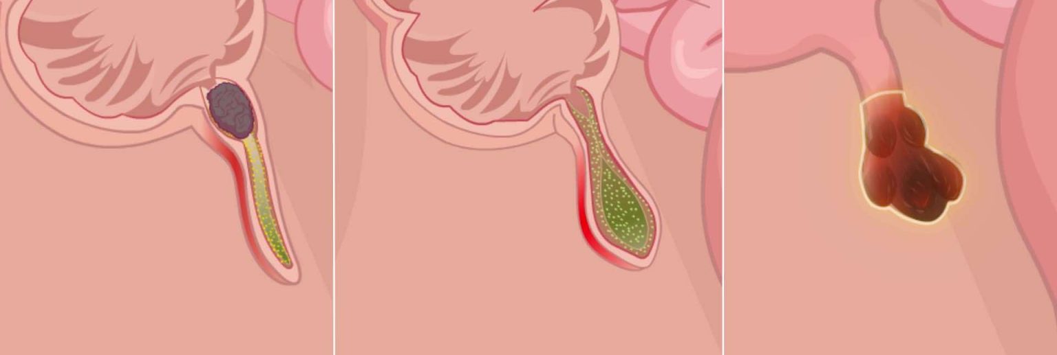 التهاب الزائدة الدودية 2