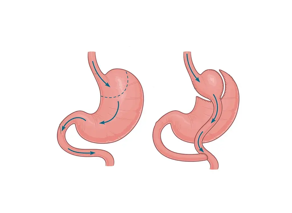 roux en y gastric bypass